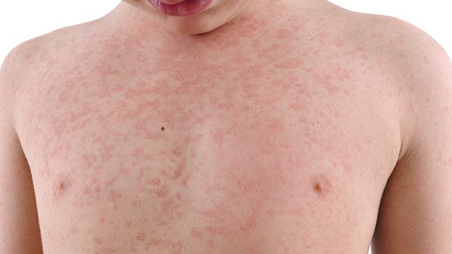 500 people possibly exposed to measles in Portland