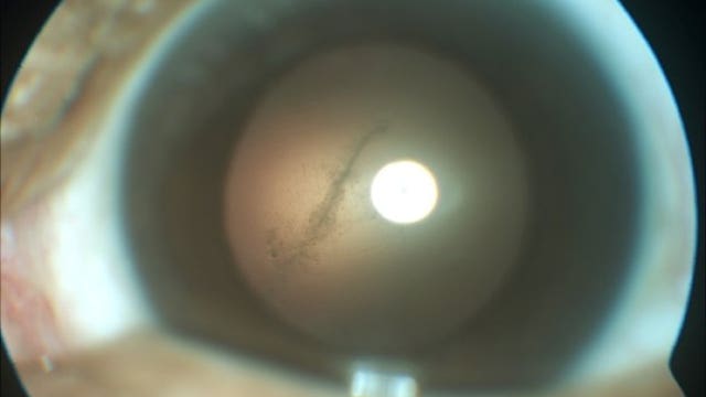 Brain-eating worm grows in Florida man's eye