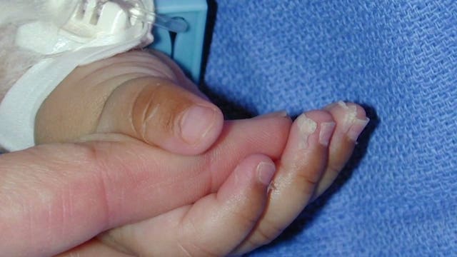 Seattle sees 1st case of childhood disease tied to coronavirus