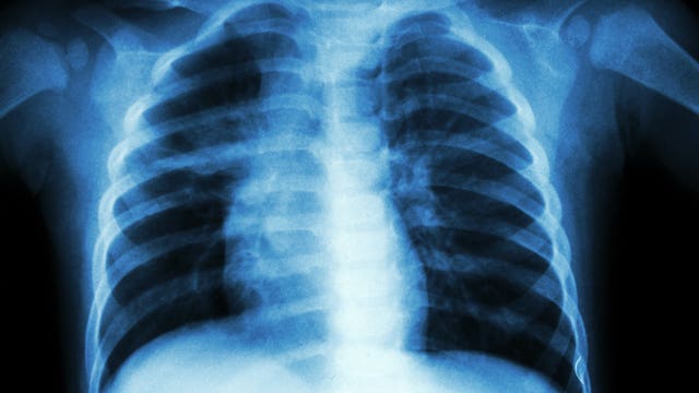 Woman with tuberculosis refusing treatment; health department could seek court order to force her hand