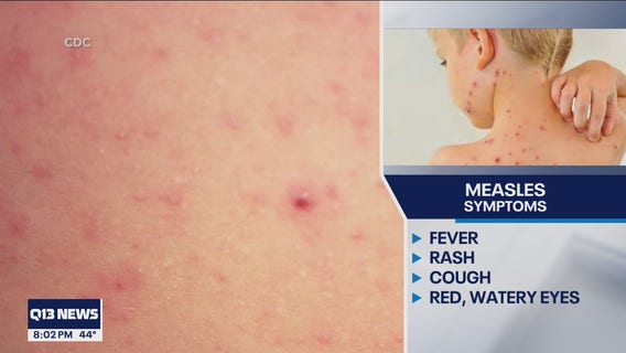 Health officials warn of possible measles exposure at Seattle-Tacoma International Airport