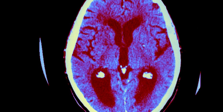 Viagra may decrease Alzheimer's disease risk up to 69%, study finds