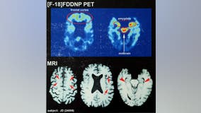 Digging deeper into traumatic brain injuries