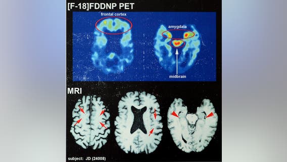 Digging deeper into traumatic brain injuries