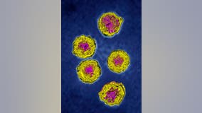 New York reports 1st US polio case in nearly a decade