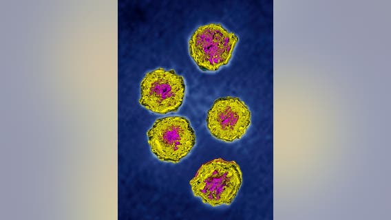 New York reports 1st US polio case in nearly a decade