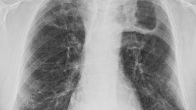 Health officials investigating tuberculosis infection in Auburn School District