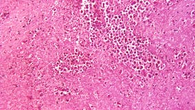 Nevada toddler dies from brain-eating amoeba