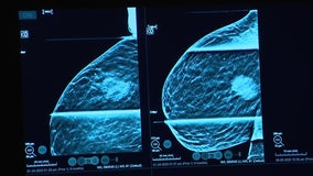 Black women face higher risk of dying from breast cancer, experts say