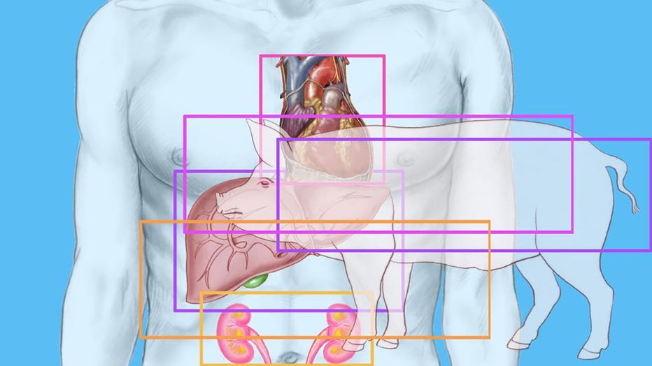 FILE - Xenotransplant is depicted in a drawing. (Photo By BSIP/Universal Images Group via Getty Images)