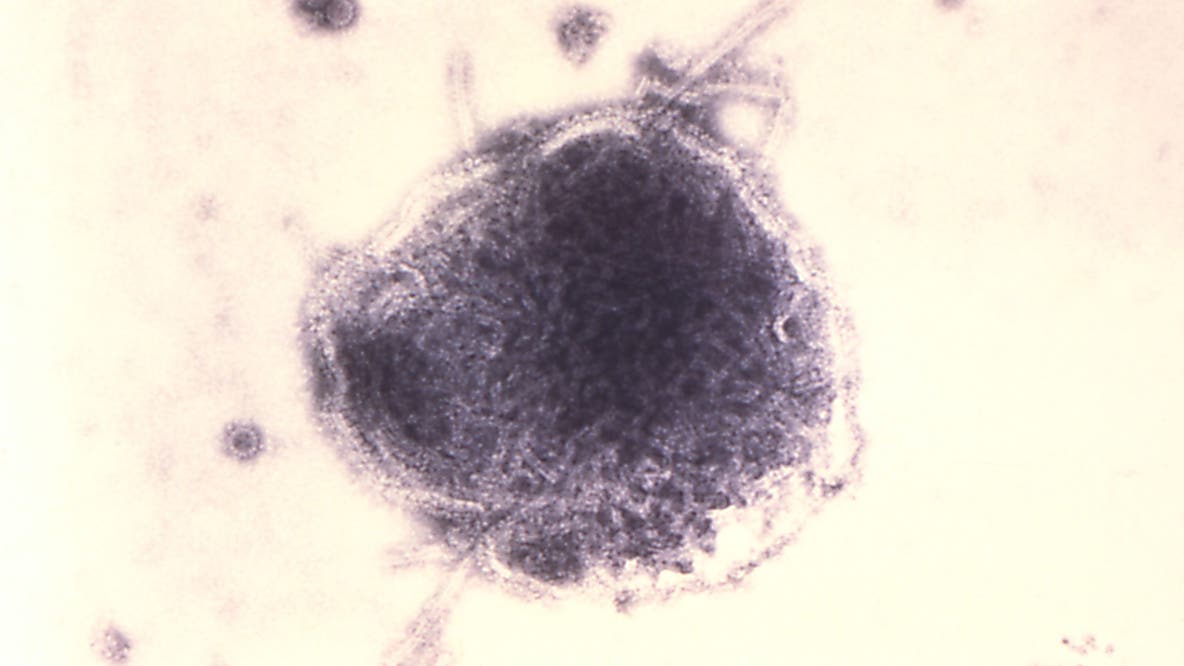 Baby with measles possibly exposed others on Seattle public transit