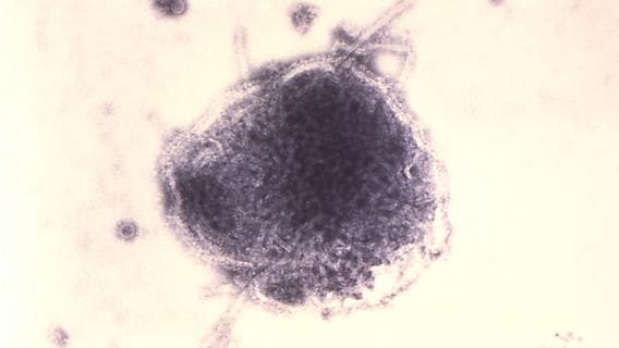 Health officials warn of possible measles exposure at Sea-Tac Airport