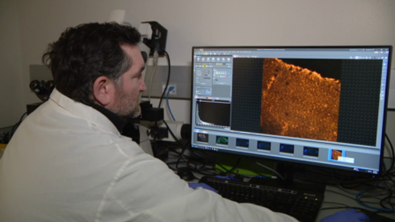 Breakthrough gene therapy in Seattle offers hope for children with epilepsy