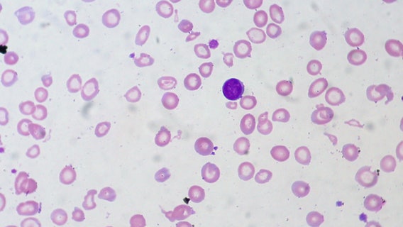 Health experts say ‘harmless’ symptoms could be signs of blood disease