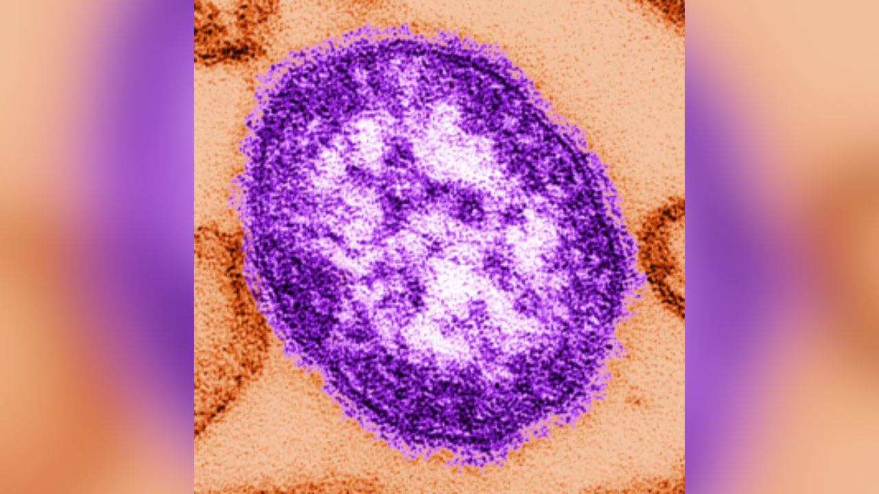 3 more kids in Snohomish County, WA test positive for measles