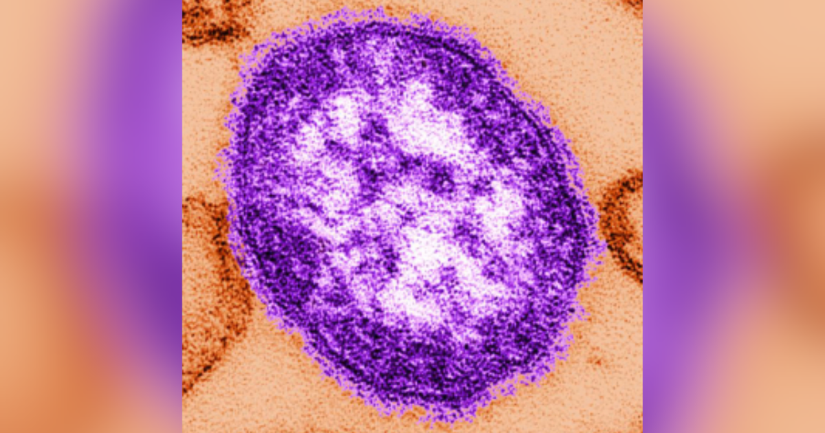 3 more kids in Snohomish County, WA test positive for measles