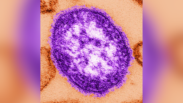 2 test positive for measles in Whatcom County, 8 WA cases confirmed in 2025