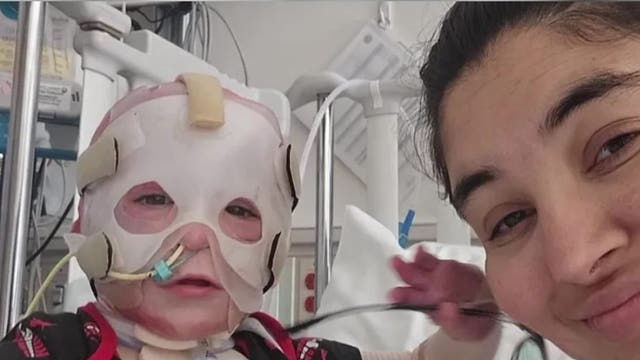 Port Angeles, WA baby burned in house fire spends months recovering in Seattle