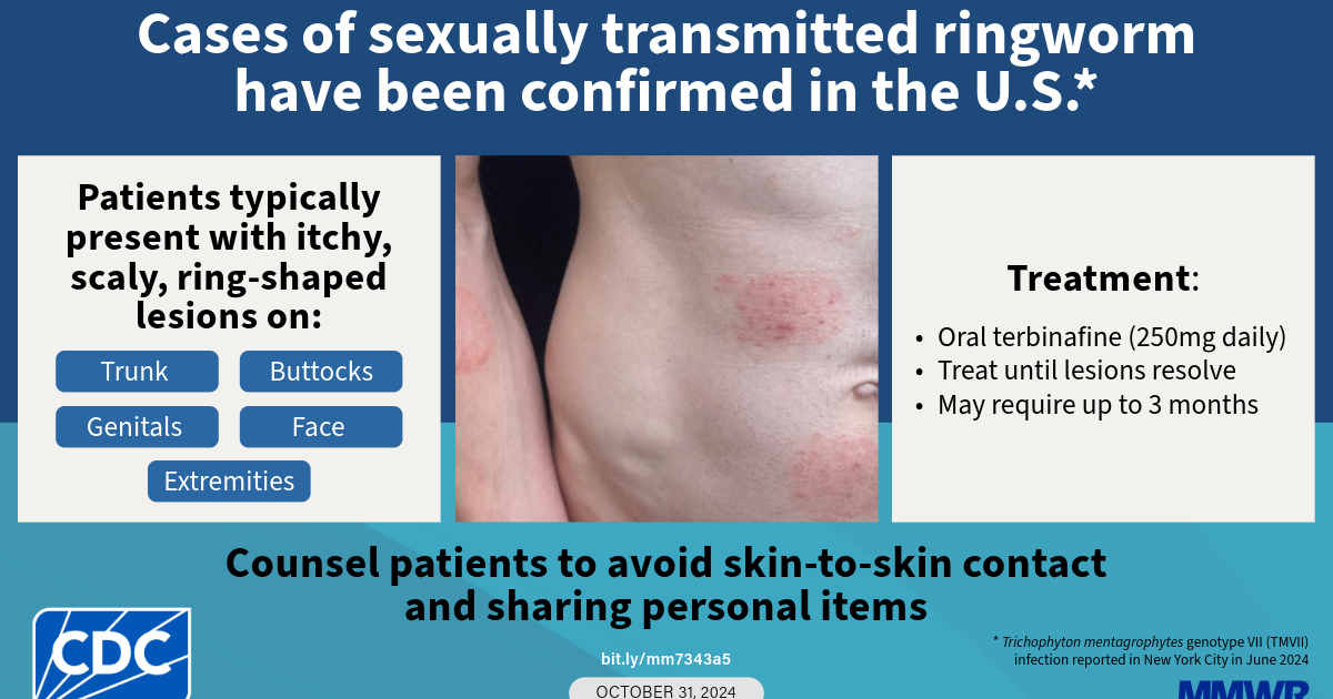 King Co. Health officials warn of new sexually transmitted infection