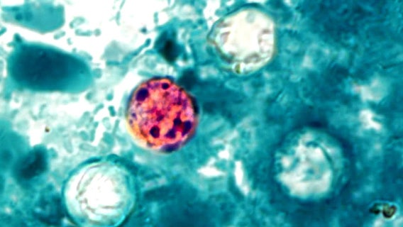 WA health expert explains cyclosporiasis symptoms, safe food practices