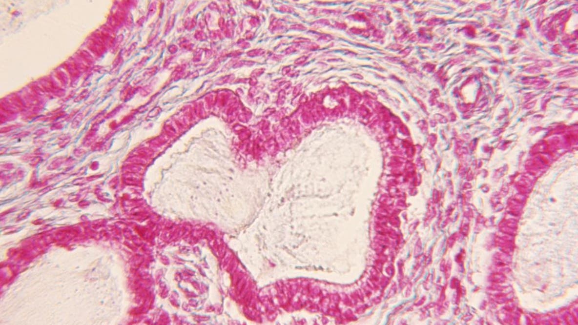 WSU researchers develop possible treatment for endometriosis