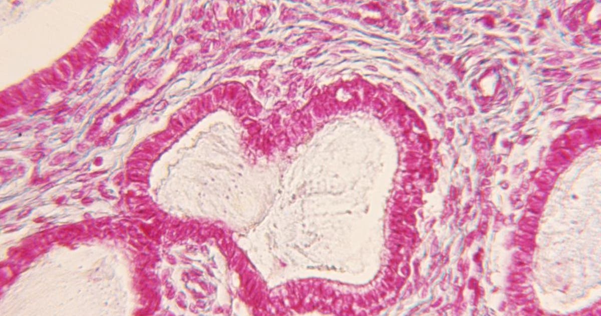 WSU researchers develop possible treatment for endometriosis