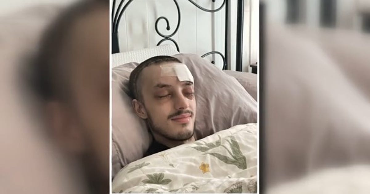 Seattle skateboarder recovering after South Lake Union hit-and-run