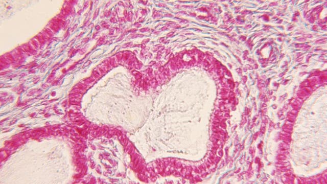 WSU researchers develop possible treatment for endometriosis
