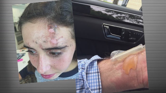 Feds reportedly investigating allegations of exploding NutriBullets; more victims come forward