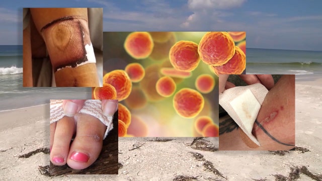 More cases of flesh-eating bacteria reported in Florida