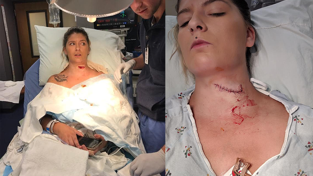 Woman survives freak lawn mower accident that left her neck sliced open