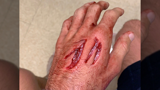 Shark attacks teen surfer at New Smyrna Beach