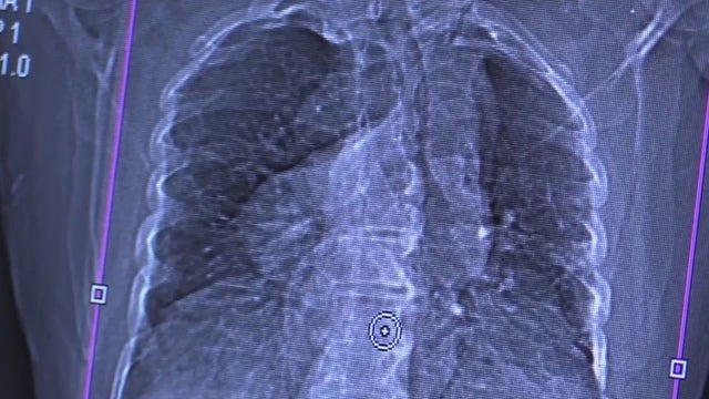 Long-haul COVID cases now considered a disability