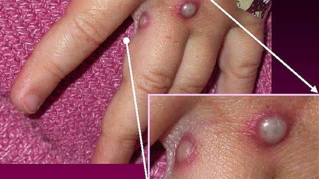 Monkeypox in Florida: Symptoms to watch for