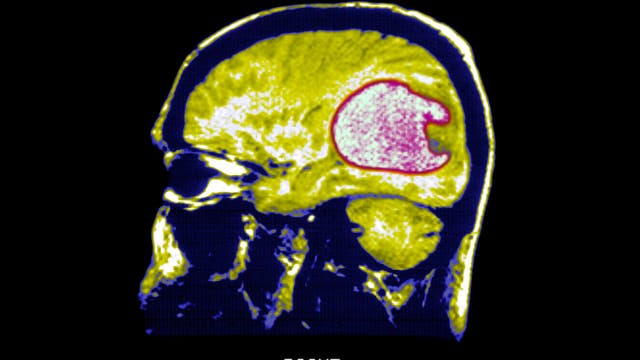 Scientists use new strategy to successfully shrink tumors in early brain cancer trials